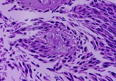 Pembrolizumab and Enfortumab Vedotin-ejfv Approved for Muscle-invasive Bladder Cancer