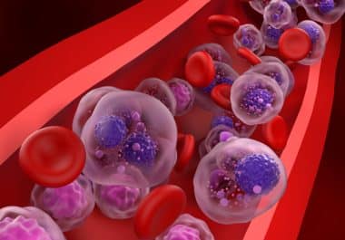 First-ever Treatment Approved for Smoldering Myeloma Comes With Questions