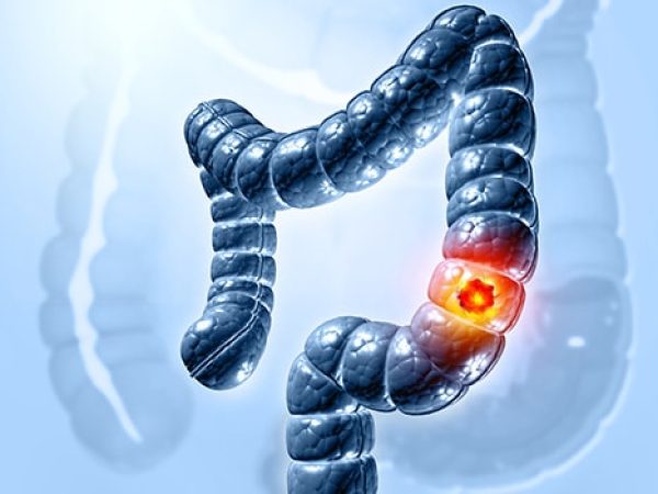 What Are the Options for Colorectal Cancer Screening?