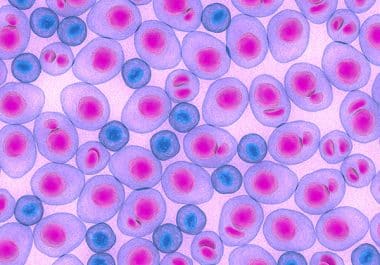 Bloodlines Series: What Is Smoldering Myeloma?