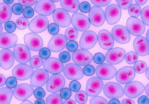 Bloodlines Series: What Is Smoldering Myeloma?
