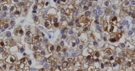 AACR Special Conference: Liver Cancer