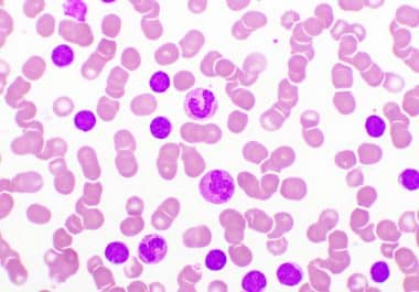 Noncovalent BTK Inhibitor Granted Traditional Approval for Certain Lymphomas