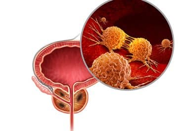 PARP Inhibitor Combination Approved for Metastatic Prostate Cancer Sensitive to Hormone Therapy