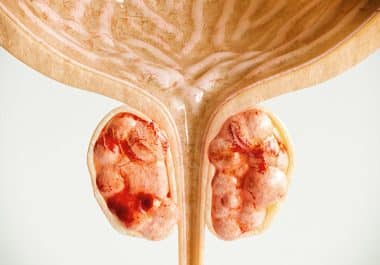 PARP Inhibitor Approved for Subtype of Advanced Prostate Cancer