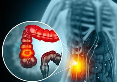 Targeted Combination Therapy Approved for BRAF-mutated Metastatic Colorectal Cancer