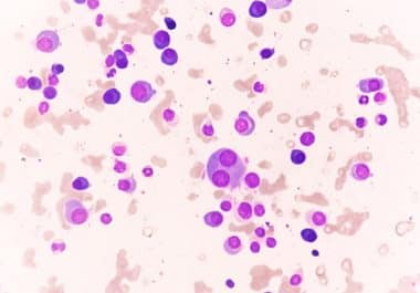 Immunotherapy Combination for Advanced Multiple Myeloma