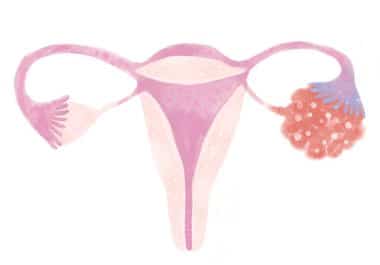 A First-in-class Glucocorticoid Receptor-targeted Therapy for Gynecologic Cancers