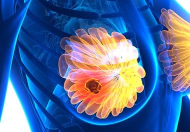 Trastuzumab Deruxtecan Approved for Early-stage Breast Cancer