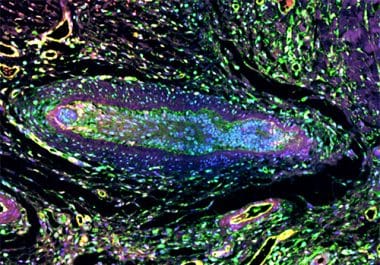 Editors’ Picks, May 2026: Insights Into CAR T Therapy, Neuron-Tumor Crosstalk in Pancreatic Cancer, and More