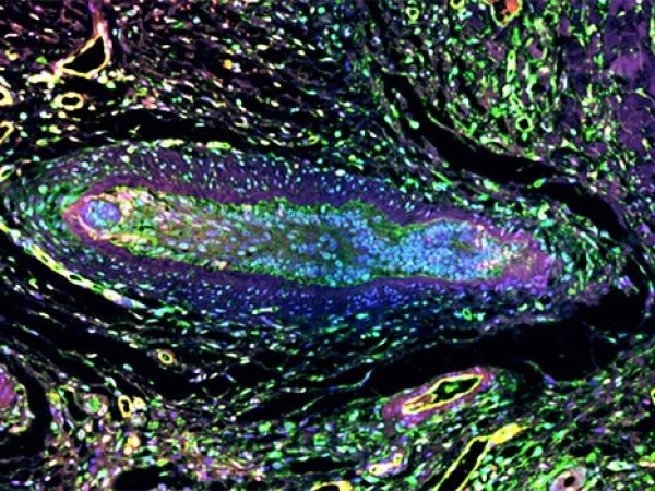 Editors’ Picks, May 2026: Insights Into CAR T Therapy, Neuron-Tumor Crosstalk in Pancreatic Cancer, and More