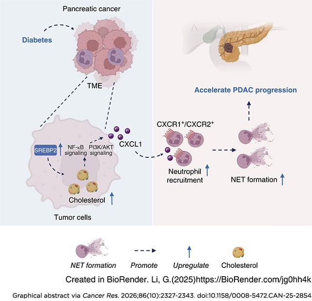Diabetes promotes pancreatic cancer progression via increased cholesterol synthesis, neutrophil recruitment, and NET formation.