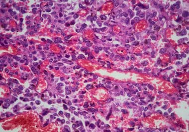 HER2 Inhibitor Approved for Certain HER2-mutated Lung Cancers