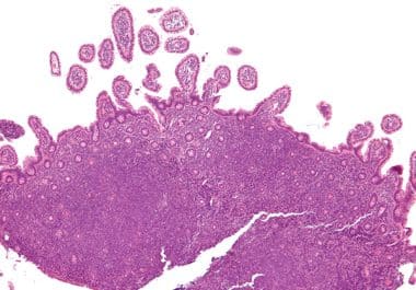 Sonrotoclax Approved as a New Targeted Therapy for Mantle Cell Lymphoma