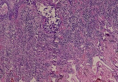 Palbociclib Approved for HR-positive, HER2-positive Advanced Breast Cancer