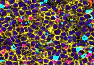 From Discovery to Clinical Impact: AACR Special Conference Captured the Spectrum of Lymphoma Research