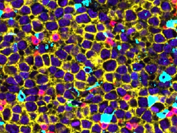 From Discovery to Clinical Impact: AACR Special Conference Captured the Spectrum of Lymphoma Research