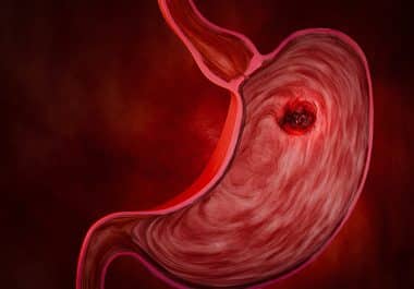 Tislelizumab and Chemotherapy Approved as First-line Option for Stomach and Gastroesophageal Junction Cancers