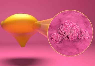 Immunotherapy Approved in Combination With BCG for High-risk Bladder Cancer