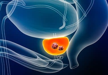 First AKT Inhibitor Approved for Prostate Cancer