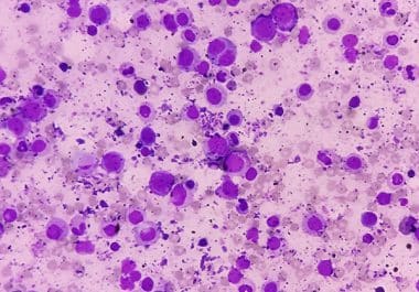 First Treg Immunotherapy for Blood Cancers 