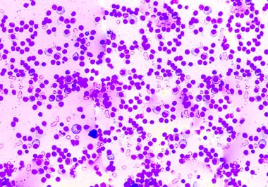 Subcutaneous Isatuximab Approved for Several Multiple Myeloma Indications