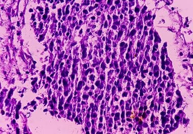 Pembrolizumab and Enfortumab Vedotin-ejfv Approved for More Patients With MIBC