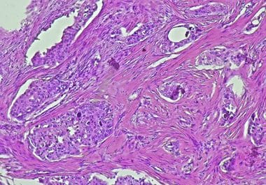 New Kinase Inhibitor Approved for Certain Metastatic Breast Cancers