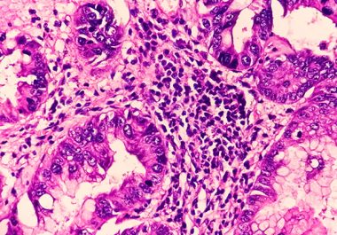 Radiotherapy With Hormone Therapy Approved for Metastatic Prostate Cancer With Hormone Sensitivity