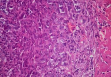 New Targeted Therapy Approved for ROS1-positive Lung Cancer