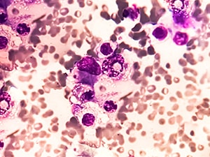 Multiple myeloma tissue.
