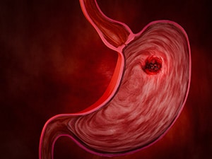 A close-up illustration of the stomach with a tumor inside of it.