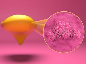 Diagram of a bladder with zoomed in look at cancer cells