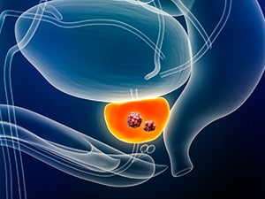 Diagram of a prostate with two tumors