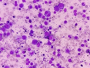 Blood smear microscopy image showing abnormal hematological cells.
