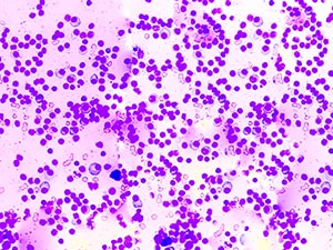 A photomicrograph of multiple myeloma cells on a histopathology slide.