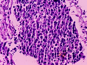 Bladder cancer tissue under a microscope. 