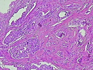 Breast cancer cells on a histopathology slide.