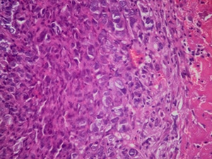 Micrograph of lung tissue adenocarcinoma.