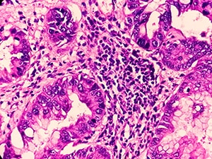 A photomicrograph of prostate cancer cells on a histopathology slide.