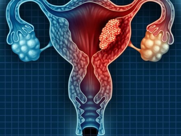 Shining a Light on Uterine Cancer: Rising Incidence and Mortality, Persistent Inequities