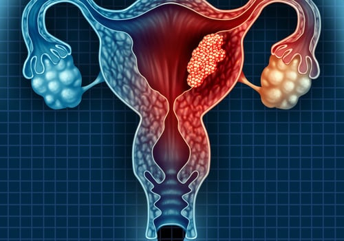Shining a Light on Uterine Cancer: Rising Incidence and Mortality, Persistent Inequities