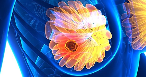 Antibody-drug Conjugate Therapy for Early-stage Breast Cancer