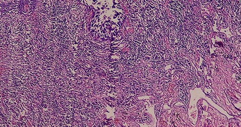 First CDK4/6 Inhibitor for HR+ / HER2+ Advanced Breast Cancer