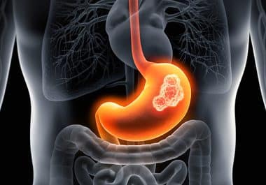 New First-line Treatments for Gastroesophageal Cancers