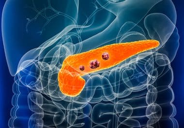 FDA Approves Daraxonrasib as First RAS Inhibitor for Pancreatic Cancer