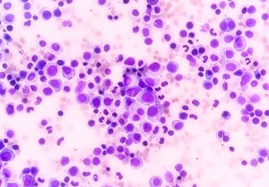 First-in-class Drug Rusfertide Approved for Polycythemia Vera