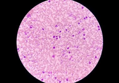 First Approval for Rare Blood Cancer in Nearly 30 Years  