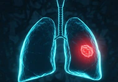 HER2 Inhibitor Approved for Certain Newly Diagnosed, HER2-mutant Lung Cancers