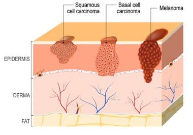 New Treatment for Basal Cell Carcinoma